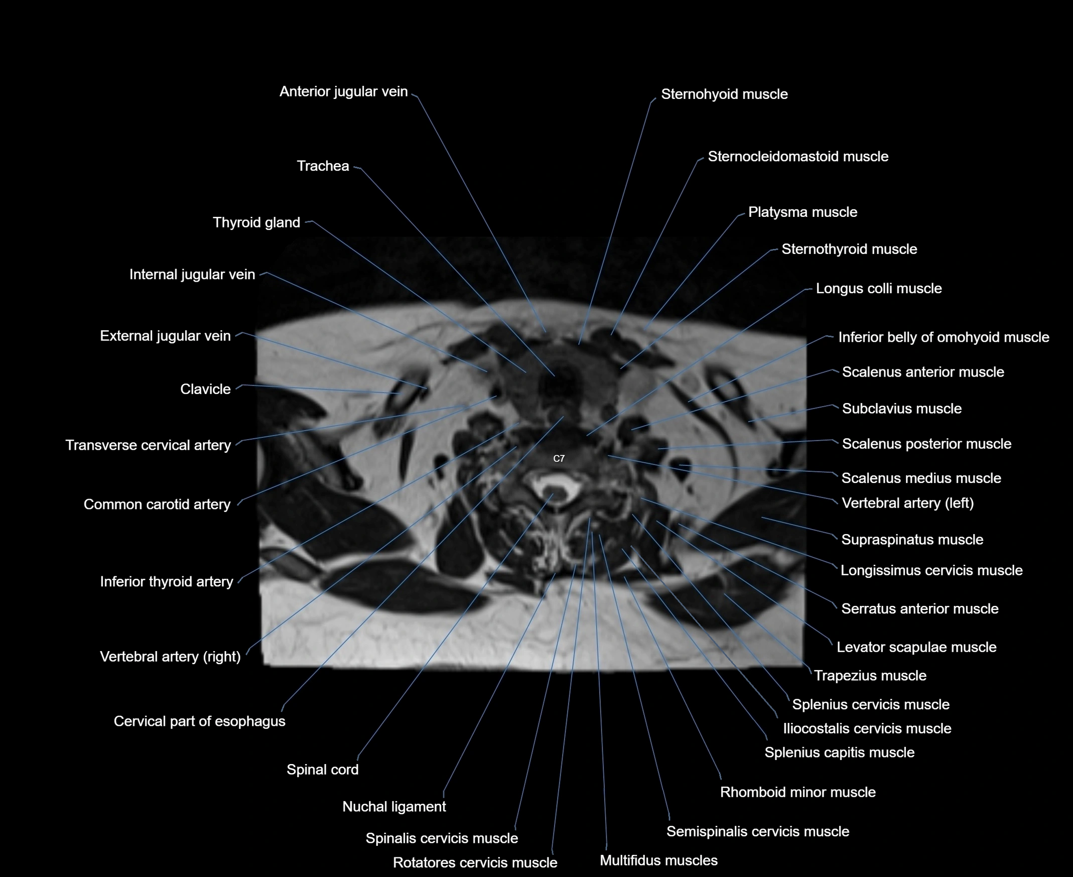 MRI Neck 3D labelled cross section anatomy axial 3t image-00001-00075.webp